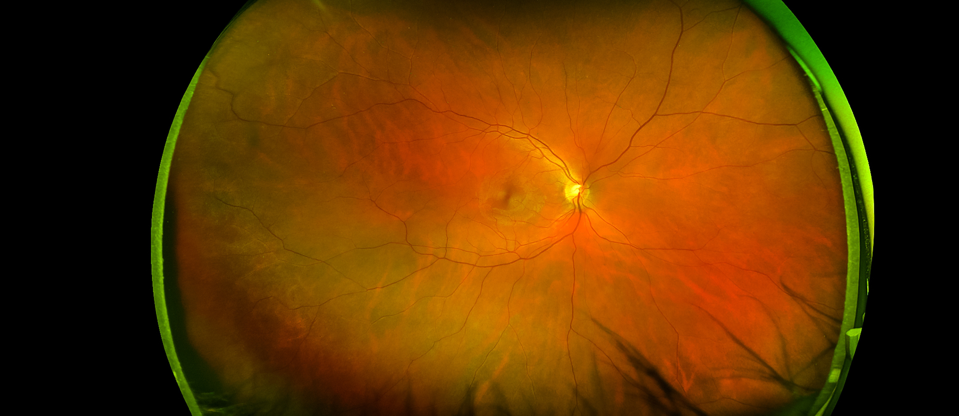 Scan of eye